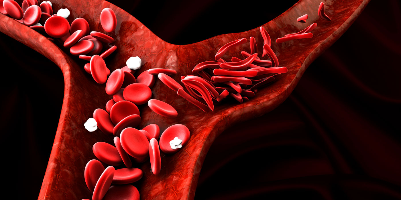 Sickle Cell Anaemia Management Nice Guidelines