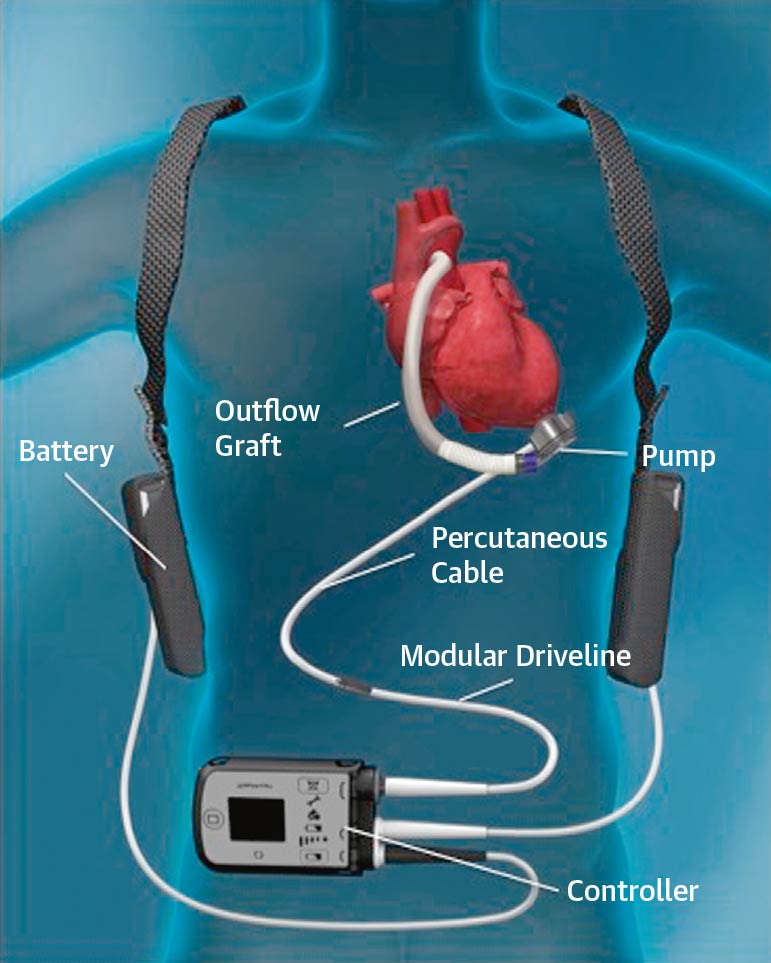 Bionic women and men: Heart failure and an artificial heart pump